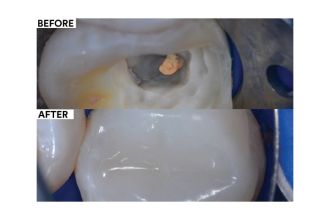 Posterior Composite Injection Over-Molding Following Root Canal Treatment