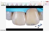 Prof.Dr.Hande Şar Sancaklı İle Kompozit Lamina İle İdeal Estetik İçin Klinik İpuçları Online Eğitim